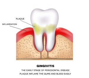 Gingivitus